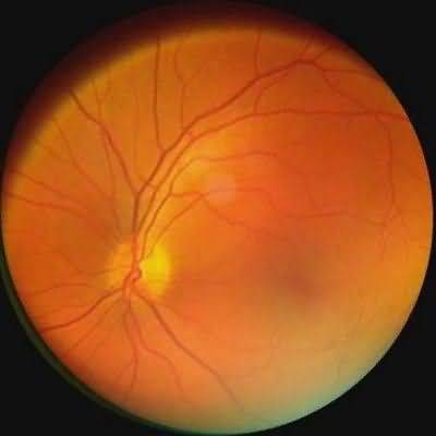central branch retinal artery occlusions